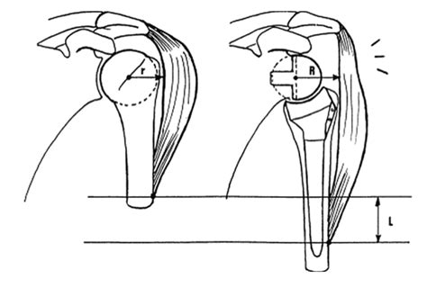 reverse total shoulder orthobullets